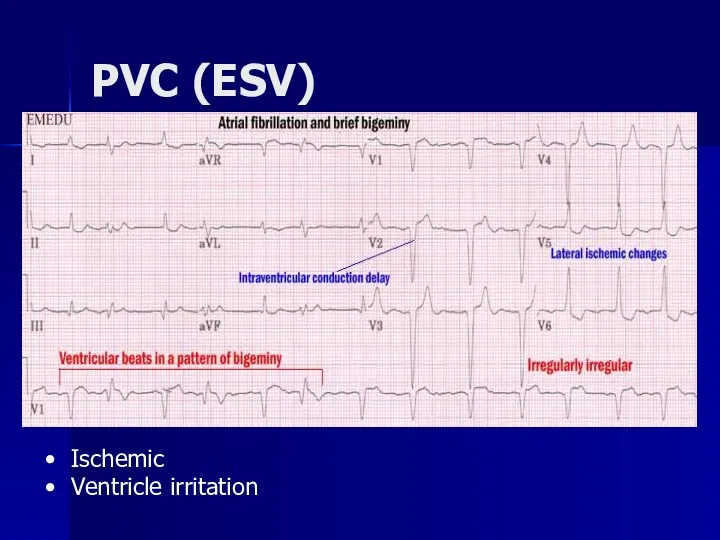 PVC (ESV) Ischemic Ventricle irritation