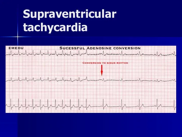 Supraventricular tachycardia