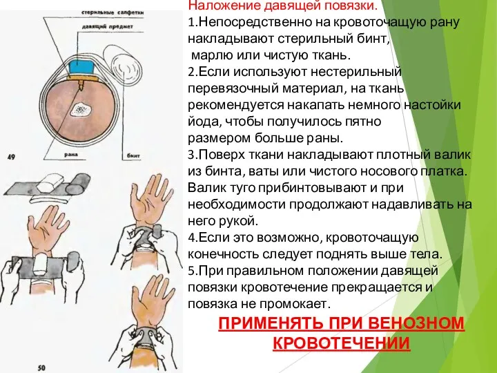 Наложение давящей повязки. 1.Непосредственно на кровоточащую рану накладывают стерильный бинт,