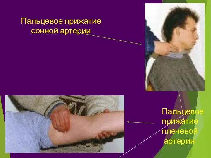 Пальцевое прижатие сонной артерии Пальцевое прижатие плечевой артерии