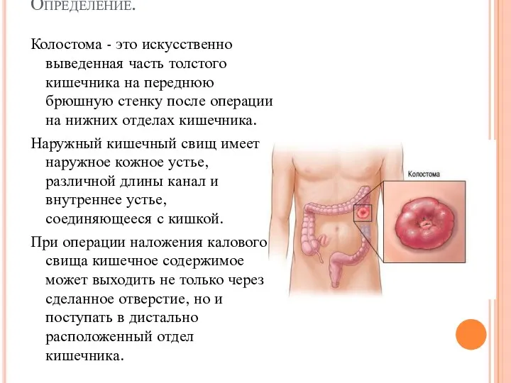 Определение. Колостома - это искусственно выведенная часть толстого кишечника на