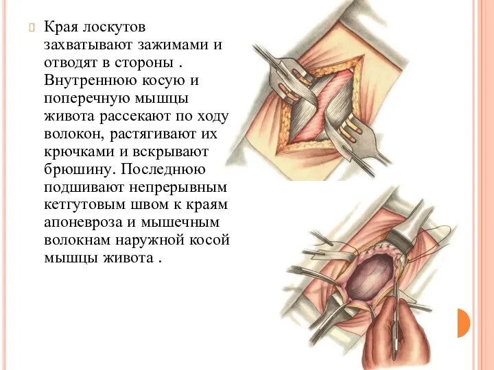 Края лоскутов захватывают зажимами и отводят в стороны .Внутреннюю косую