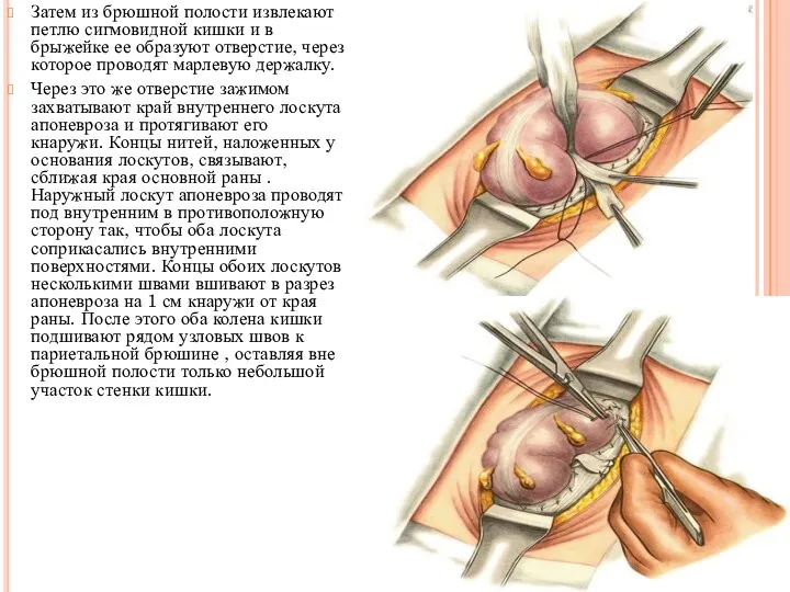 Затем из брюшной полости извлекают петлю сигмовидной кишки и в