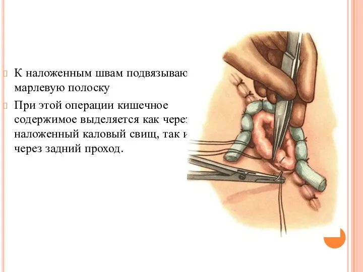 К наложенным швам подвязывают марлевую полоску При этой операции кишечное