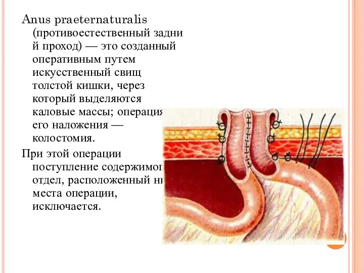 Anus praeternaturalis (противоестественный задний проход) — это созданный оперативным путем