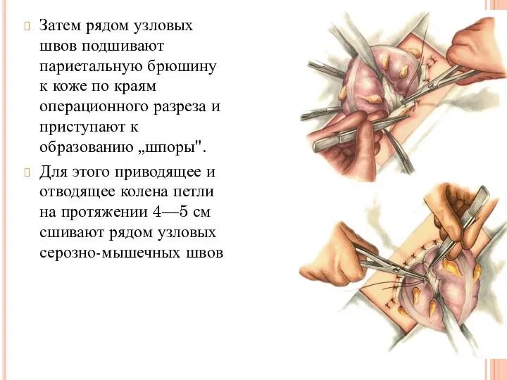 Затем рядом узловых швов подшивают париетальную брюшину к коже по