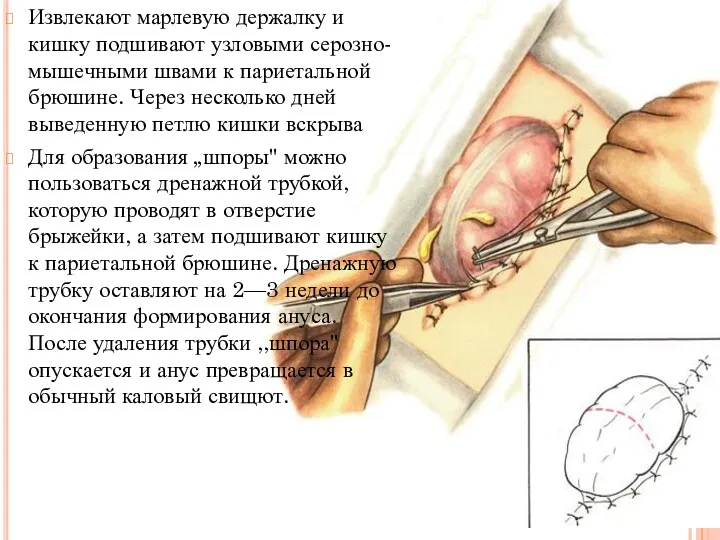 Извлекают марлевую держалку и кишку подшивают узловыми серозно-мышечными швами к