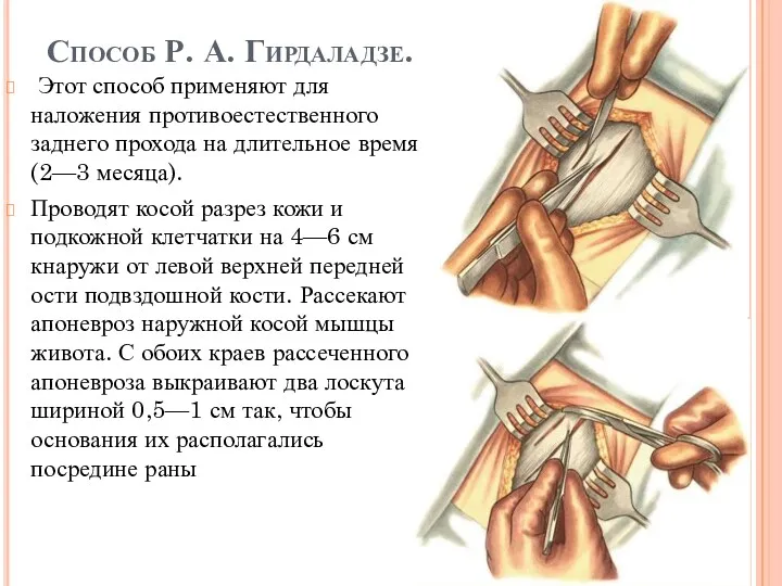 Способ Р. А. Гирдаладзе. Этот способ применяют для наложения противоестественного
