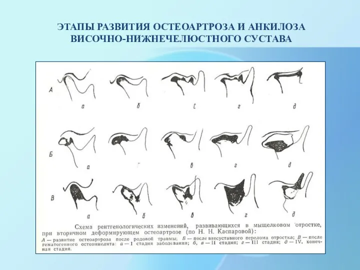 ЭТАПЫ РАЗВИТИЯ ОСТЕОАРТРОЗА И АНКИЛОЗА ВИСОЧНО-НИЖНЕЧЕЛЮСТНОГО СУСТАВА