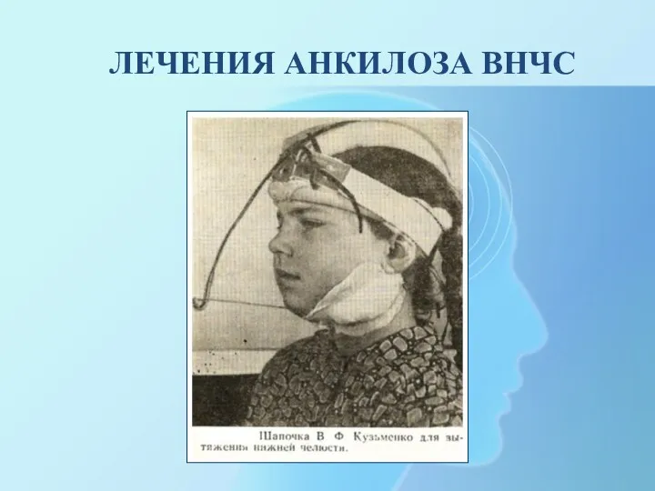 ЛЕЧЕНИЯ АНКИЛОЗА ВНЧС