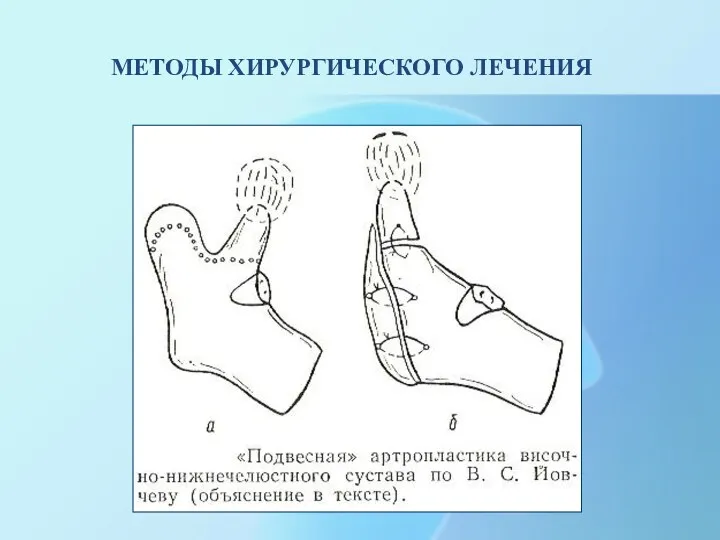 МЕТОДЫ ХИРУРГИЧЕСКОГО ЛЕЧЕНИЯ