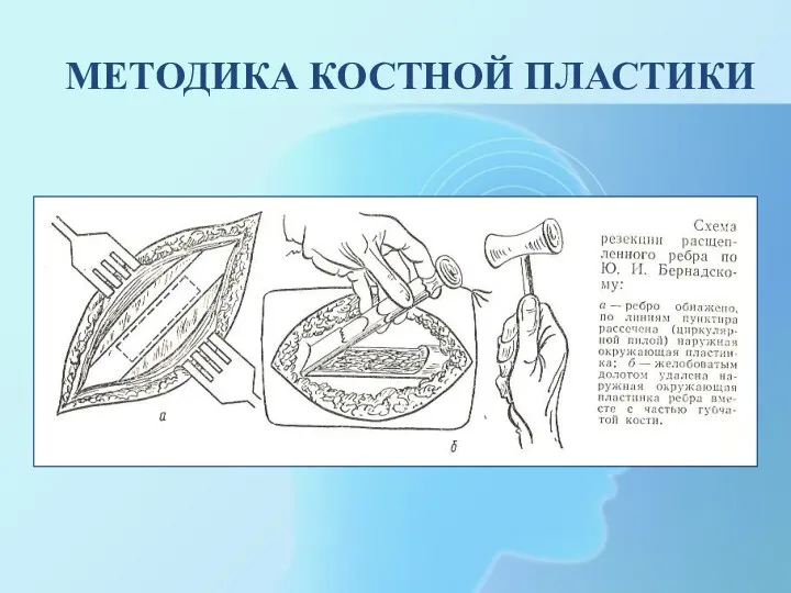 МЕТОДИКА КОСТНОЙ ПЛАСТИКИ