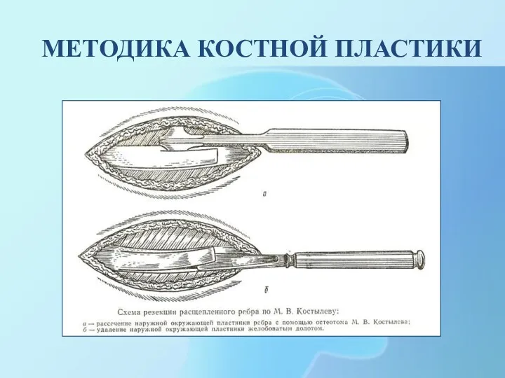 МЕТОДИКА КОСТНОЙ ПЛАСТИКИ