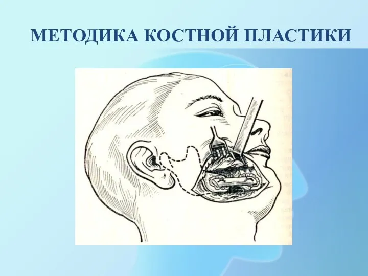 МЕТОДИКА КОСТНОЙ ПЛАСТИКИ