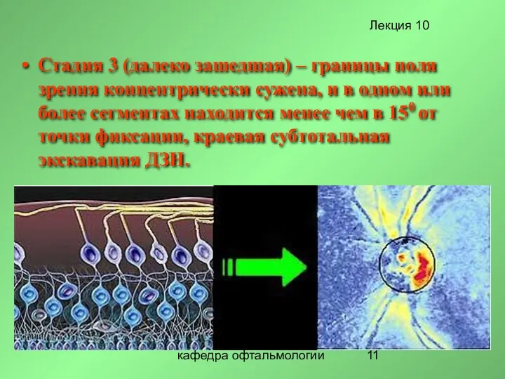 кафедра офтальмологии Стадия 3 (далеко зашедшая) – границы поля зрения