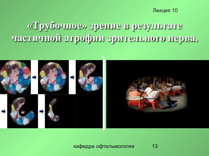 кафедра офтальмологии «Трубочное» зрение в результате частичной атрофии зрительного нерва.