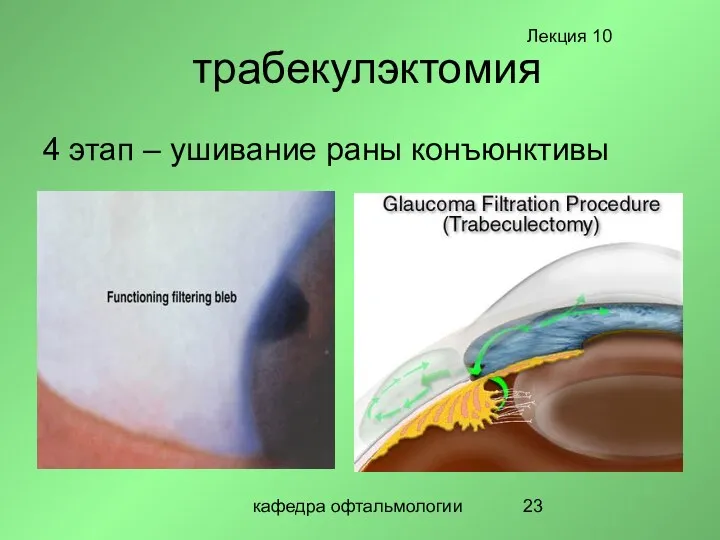 кафедра офтальмологии трабекулэктомия 4 этап – ушивание раны конъюнктивы