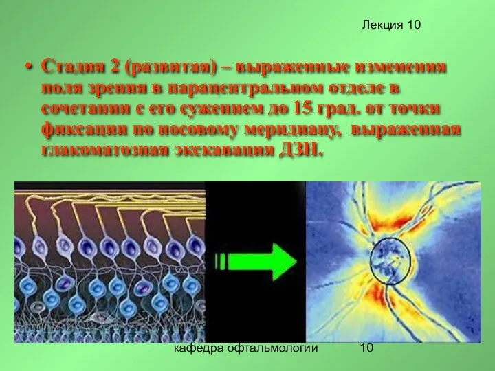 кафедра офтальмологии Стадия 2 (развитая) – выраженные изменения поля зрения