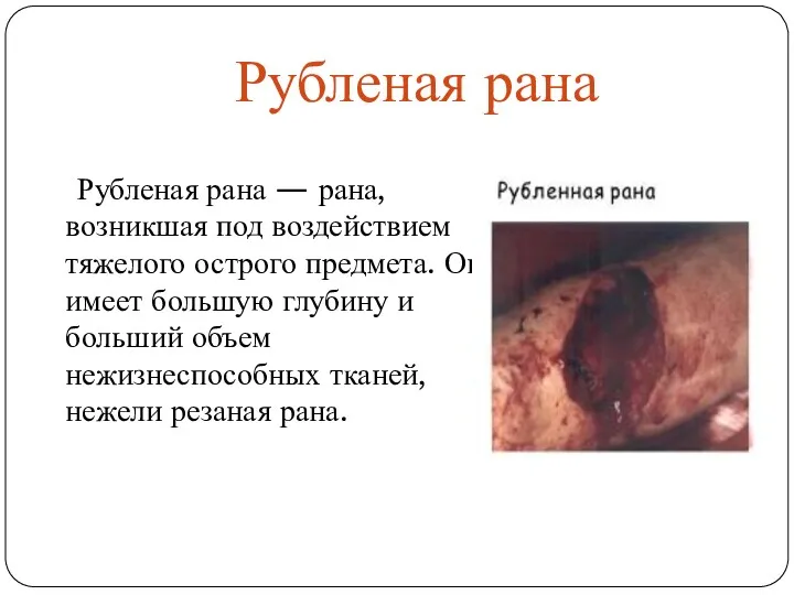 Рубленая рана Рубленая рана — рана, возникшая под воздействием тяжелого острого предмета. Она