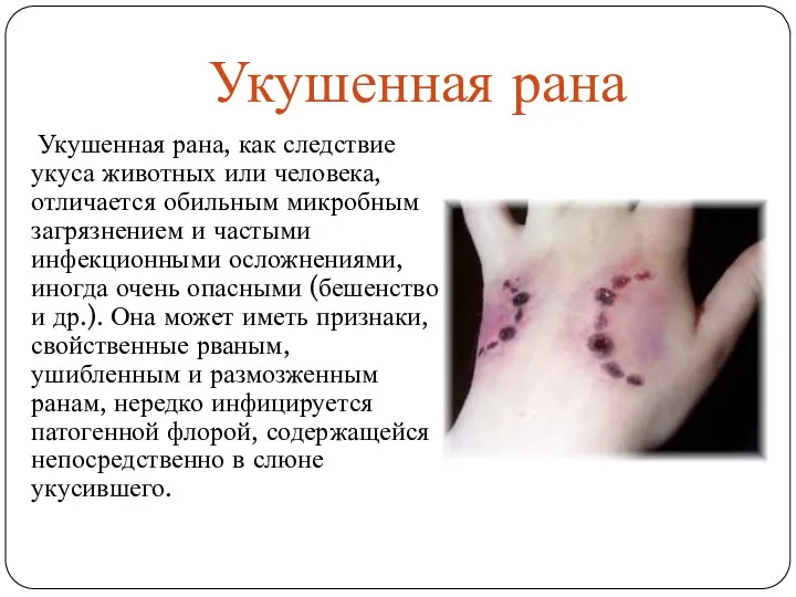 Укушенная рана Укушенная рана, как следствие укуса животных или человека, отличается обильным микробным
