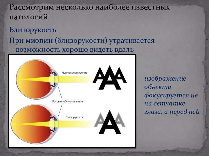 Близорукость При миопии (близорукости) утрачивается возможность хорошо видеть вдаль Рассмотрим