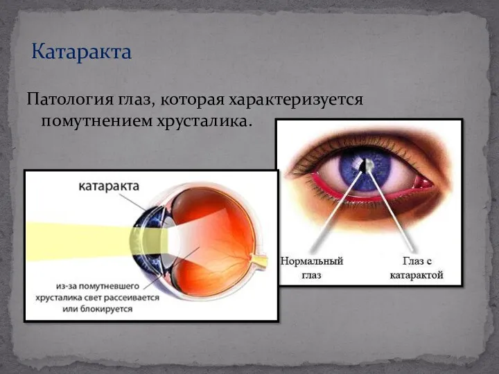 Патология глаз, которая характеризуется помутнением хрусталика. Катаракта