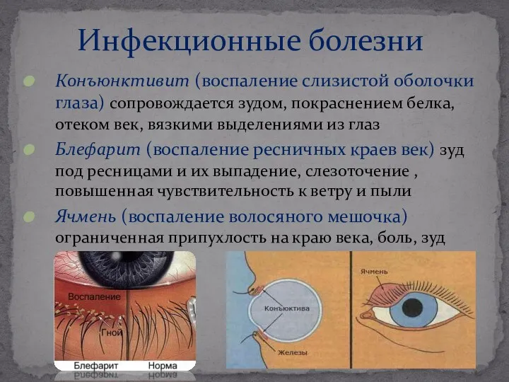 Инфекционные болезни Конъюнктивит (воспаление слизистой оболочки глаза) сопровождается зудом, покраснением