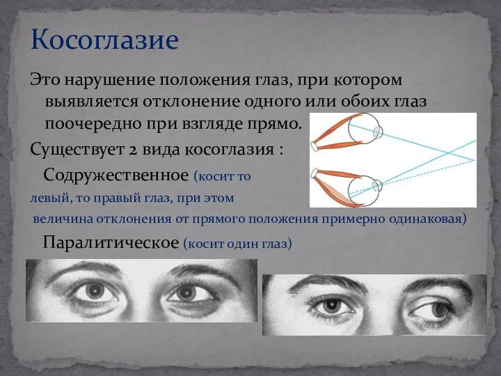 Это нарушение положения глаз, при котором выявляется отклонение одного или