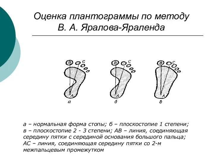 Оценка плантограммы по методу В. А. Яралова-Яраленда а – нормальная