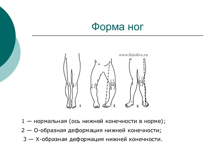 Форма ног 1 — нормальная (ось нижней конечности в норме);