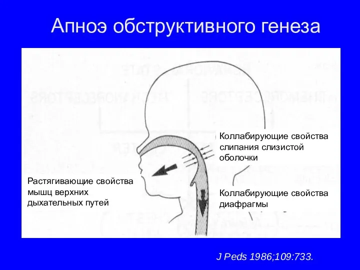 Апноэ обструктивного генеза J Peds 1986;109:733. Растягивающие свойства мышц верхних