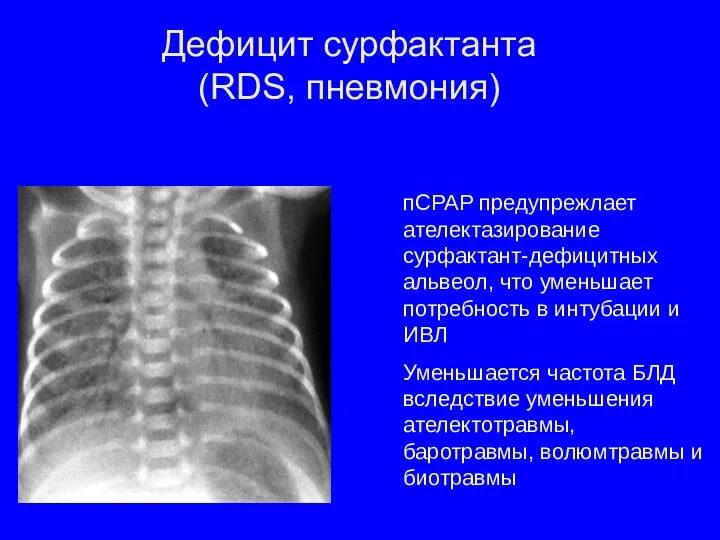 Дефицит сурфактанта (RDS, пневмония) пСРАР предупрежлает ателектазирование сурфактант-дефицитных альвеол, что