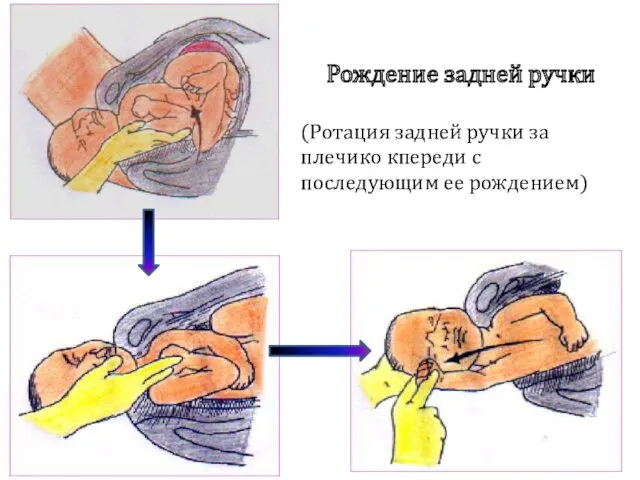 Рождение задней ручки (Ротация задней ручки за плечико кпереди с последующим ее рождением)