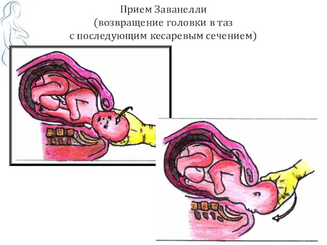 Прием Заванелли (возвращение головки в таз с последующим кесаревым сечением)