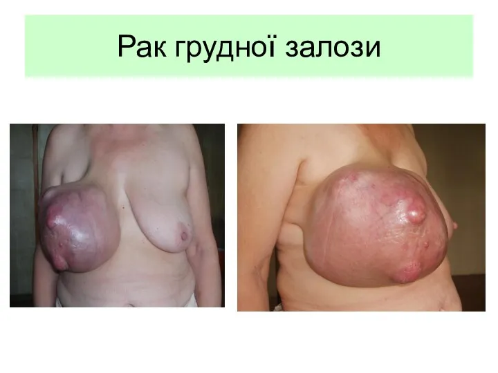 Рак грудної залози