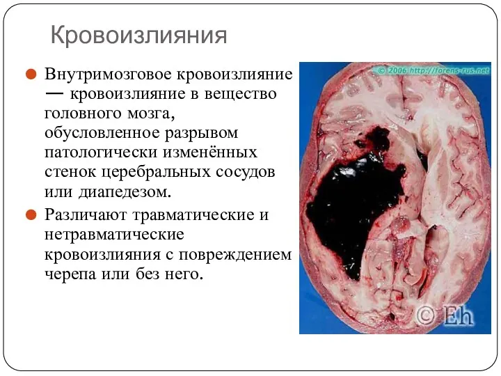 Кровоизлияния Внутримозговое кровоизлияние — кровоизлияние в вещество головного мозга, обусловленное