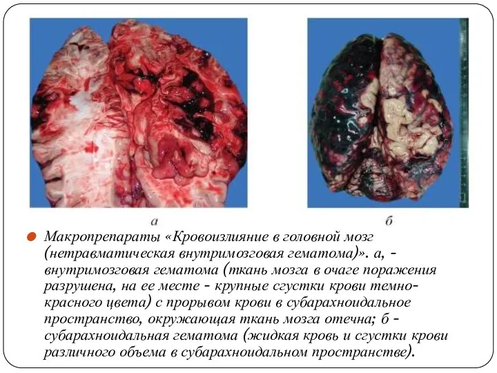 Макропрепараты «Кровоизлияние в головной мозг (нетравматическая внутримозговая гематома)». а, - внутримозговая гематома (ткань