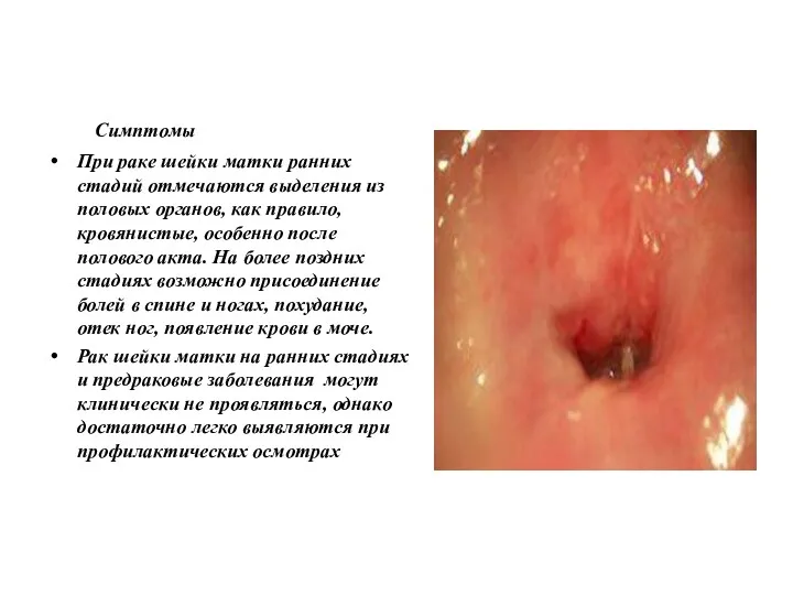 Симптомы При раке шейки матки ранних стадий отмечаются выделения из