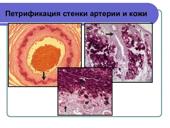 Петрификация стенки артерии и кожи