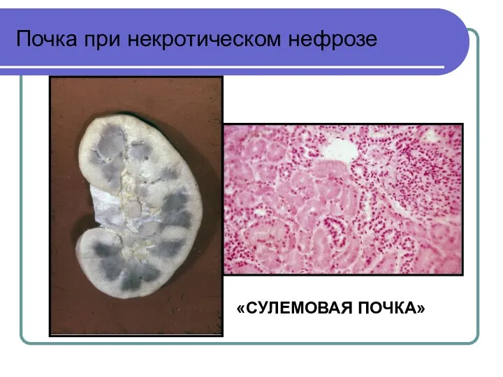 Почка при некротическом нефрозе «СУЛЕМОВАЯ ПОЧКА»