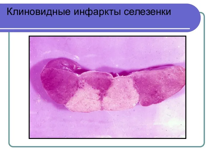 Клиновидные инфаркты селезенки