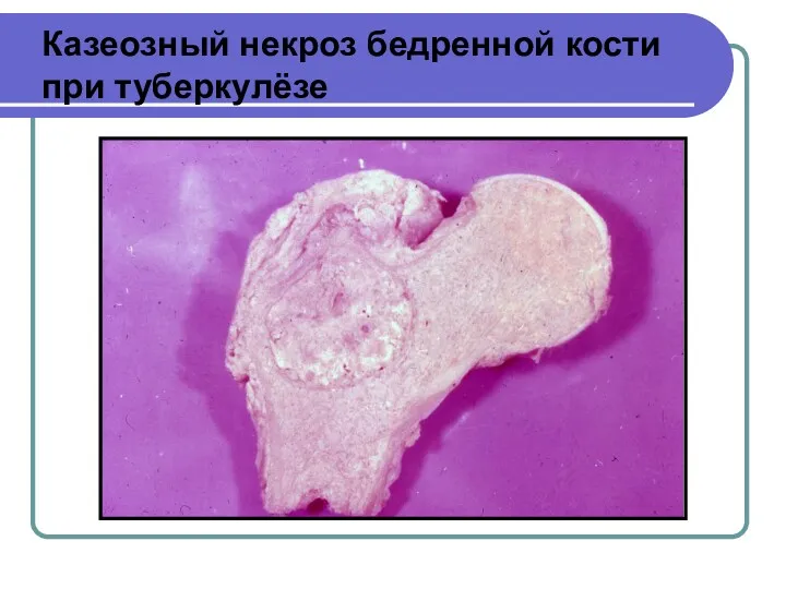 Казеозный некроз бедренной кости при туберкулёзе