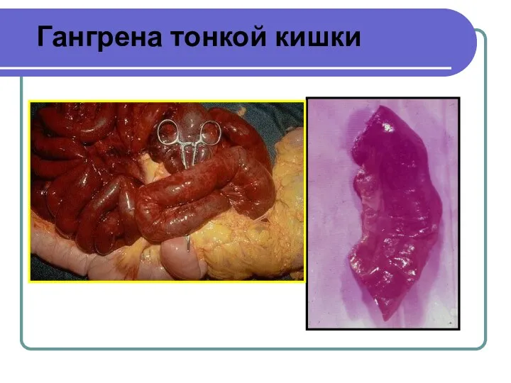 Гангрена тонкой кишки