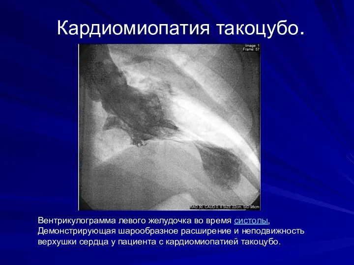 Кардиомиопатия такоцубо. Вентрикулограмма левого желудочка во время систолы, Демонстрирующая шарообразное