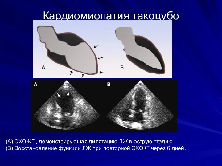 Кардиомиопатия такоцубо (A) ЭХО-КГ , демонстрирующая дилятацию ЛЖ в острую