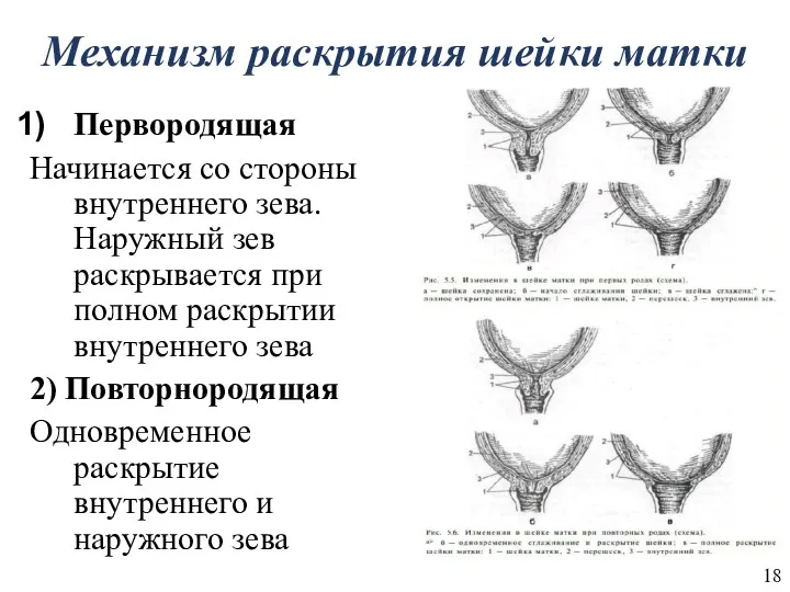 Механизм раскрытия шейки матки Первородящая Начинается со стороны внутреннего зева.