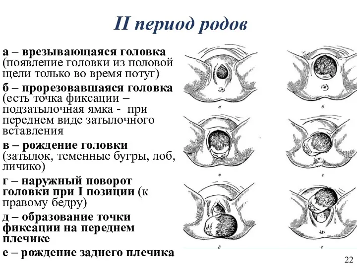 II период родов а – врезывающаяся головка (появление головки из