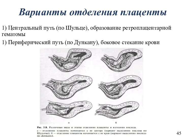 Варианты отделения плаценты 1) Центральный путь (по Шульце), образование ретроплацентарной