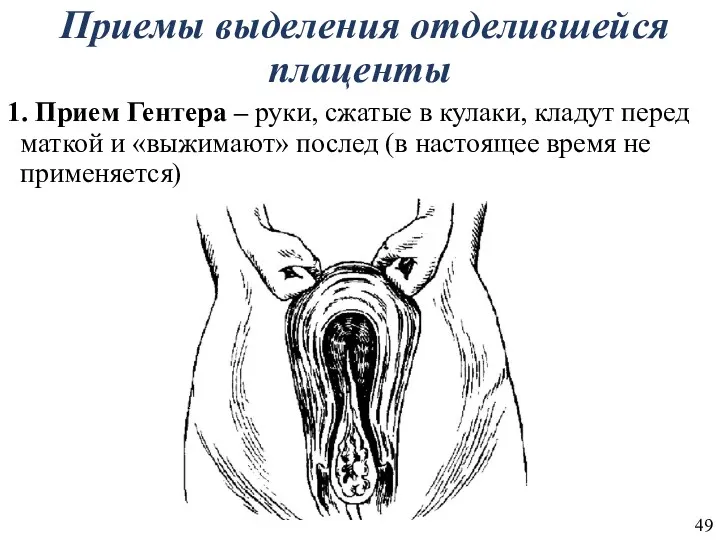 Приемы выделения отделившейся плаценты 1. Прием Гентера – руки, сжатые