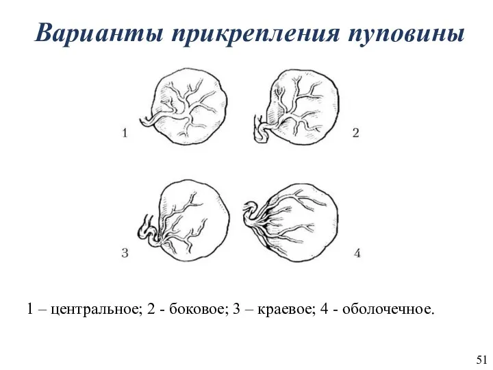 Варианты прикрепления пуповины 1 – центральное; 2 - боковое; 3 – краевое; 4 - оболочечное.